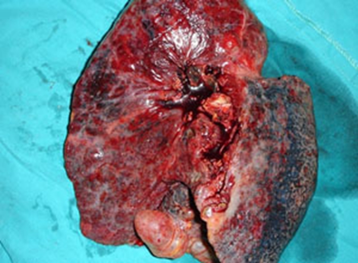 百草枯肺部纤维化图片图片