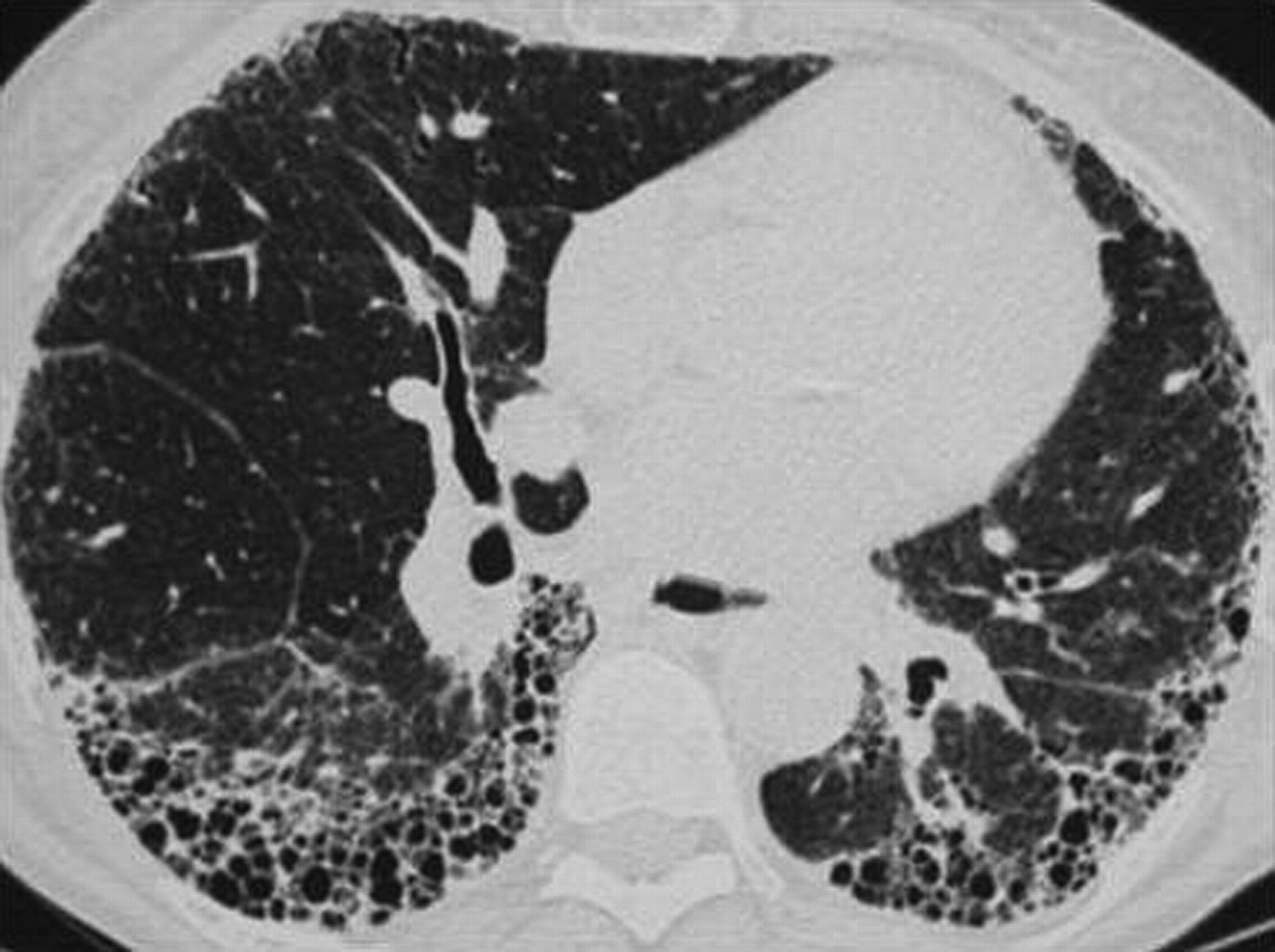 _左下肺肺纤维化影像图片_有来医生