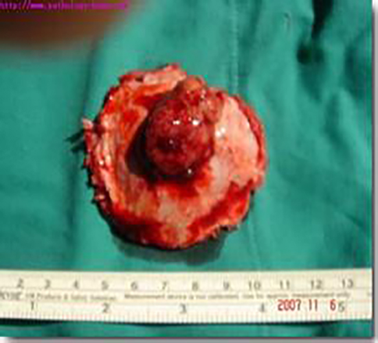 低分化滑膜肉瘤的症状图片