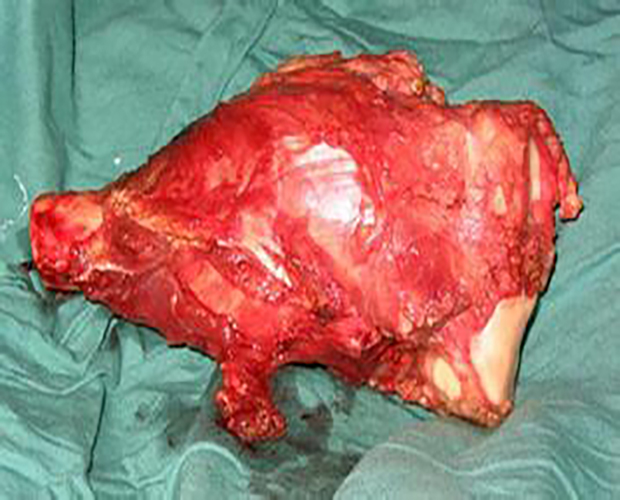 滑膜肉瘤常见肉瘤图片