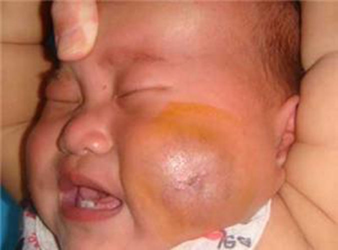 宝宝患单纯性毛细血管瘤图片