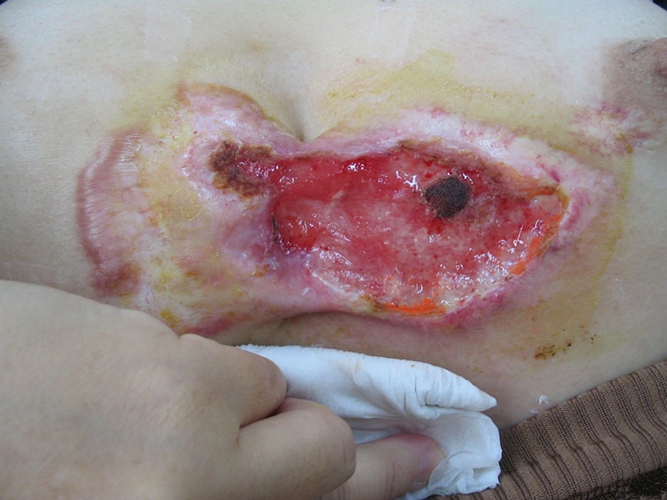 胃癌手术伤口疤痕图片图片