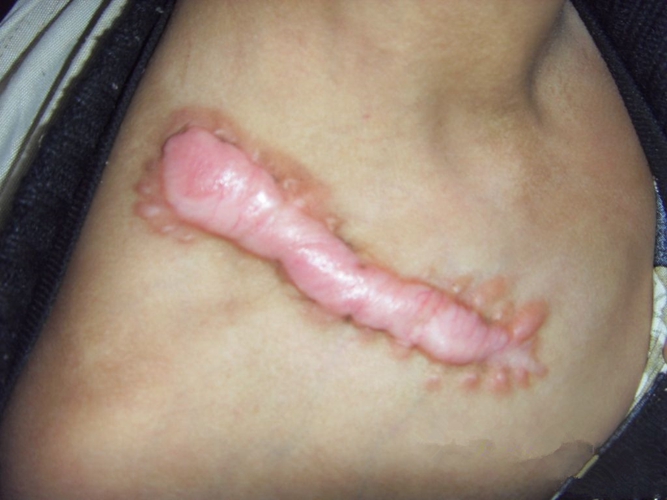 伤口深手术后增生性疤痕图片