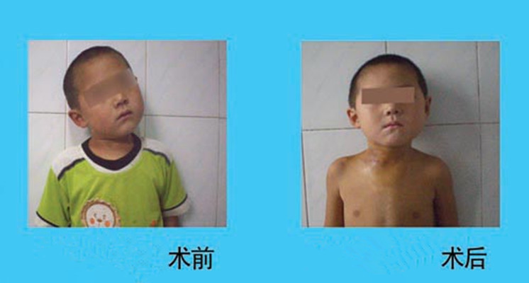 儿童痉挛性斜颈治疗前后图片