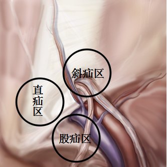 腹腔镜治疗成人腹股沟疝的四大优势