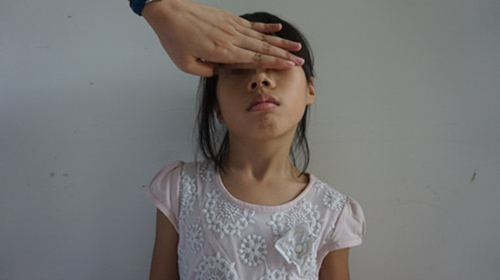 小女孩痉挛性斜颈的图片