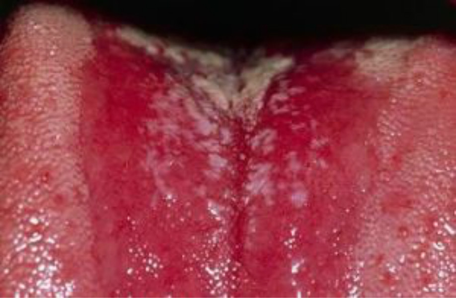 女性霉菌感染症状图片图片