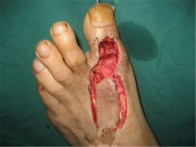脚趾骨髓炎图片图片