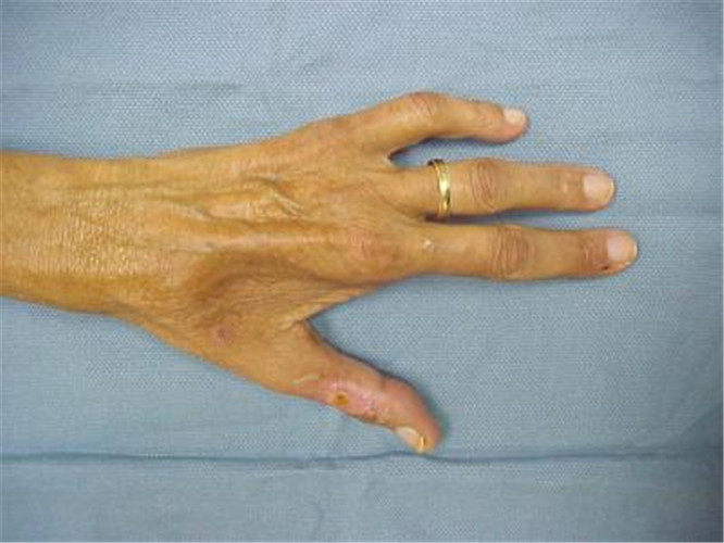 骨髓炎手部治疗图片