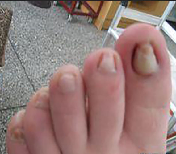 脚指甲营养不良的症状和图片