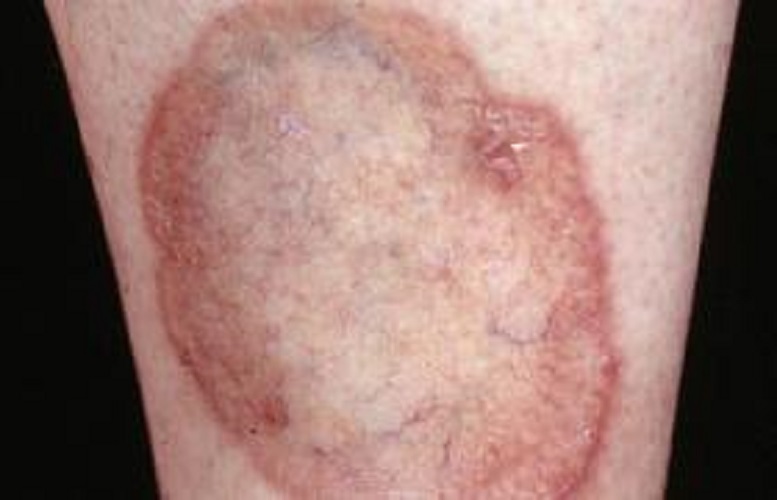 血管炎引起的结节性红斑图片