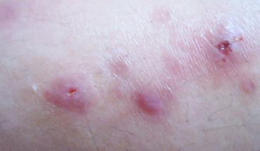 一期梅毒皮疹图片图片