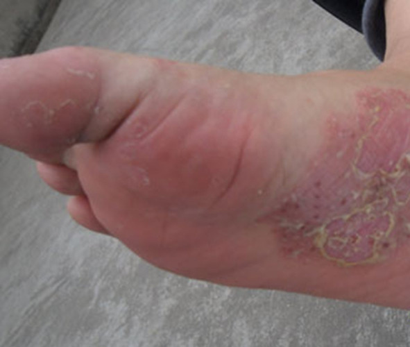 脚部慢性湿疹症状的图片