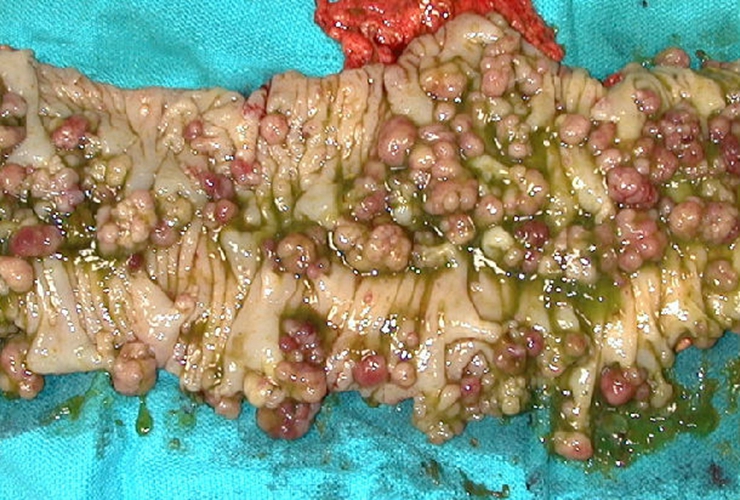 肠息肉容易癌变的图片图片