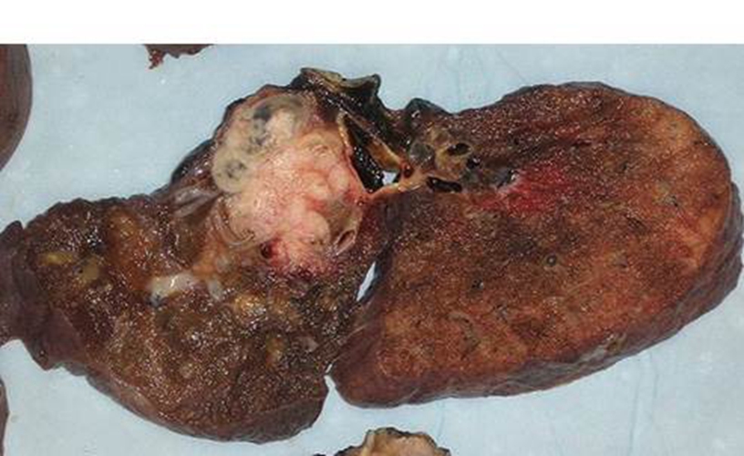 肺癌的照片图片
