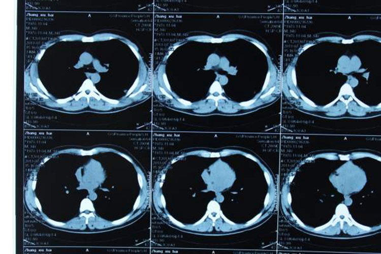 肺腺癌ct图片