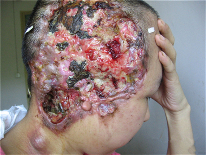 恶性肿瘤的样子图图片