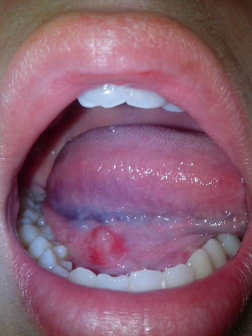  舌下腺囊肿初期症状图片
