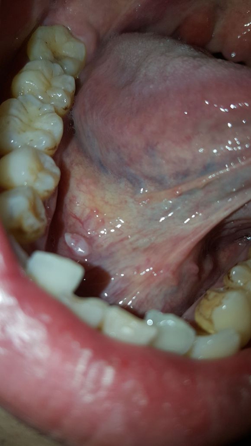  舌下腺囊肿袋形手术图片