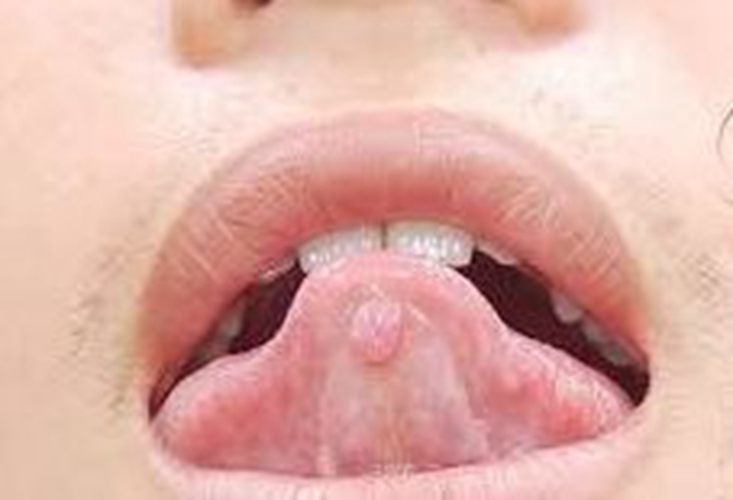  舌下腺囊肿的症状图片