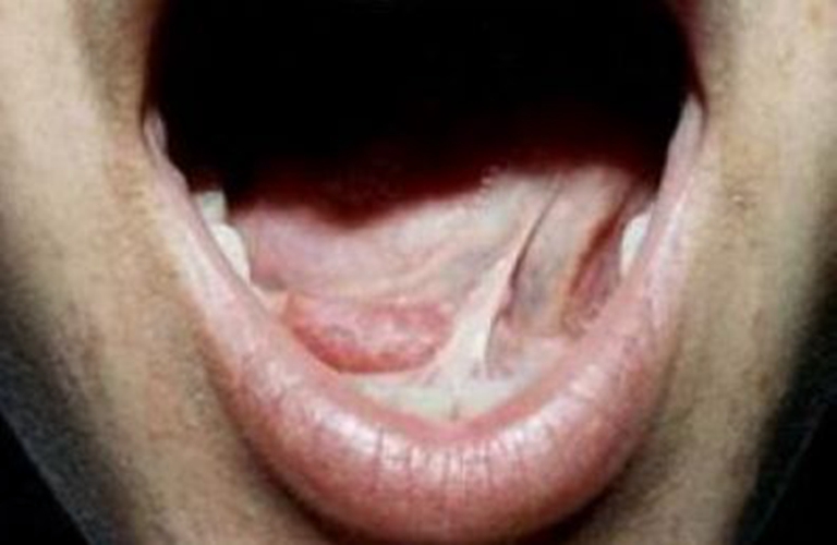  舌下腺囊肿复发的症状图片