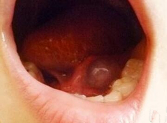 舌下腺囊肿上火图片