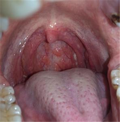急性咽炎真实图片图片