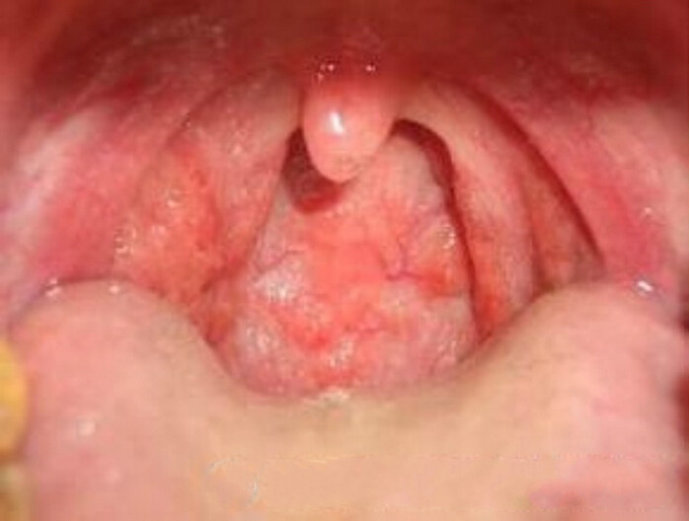 鼻咽炎口腔大图图片