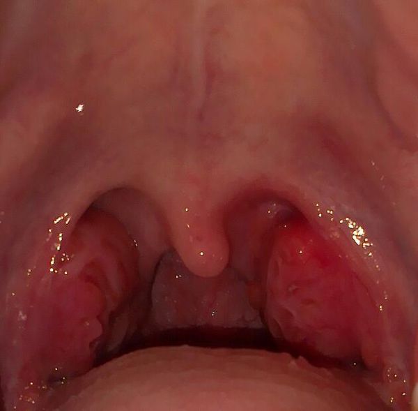 鼻咽炎咽部症状高清图片