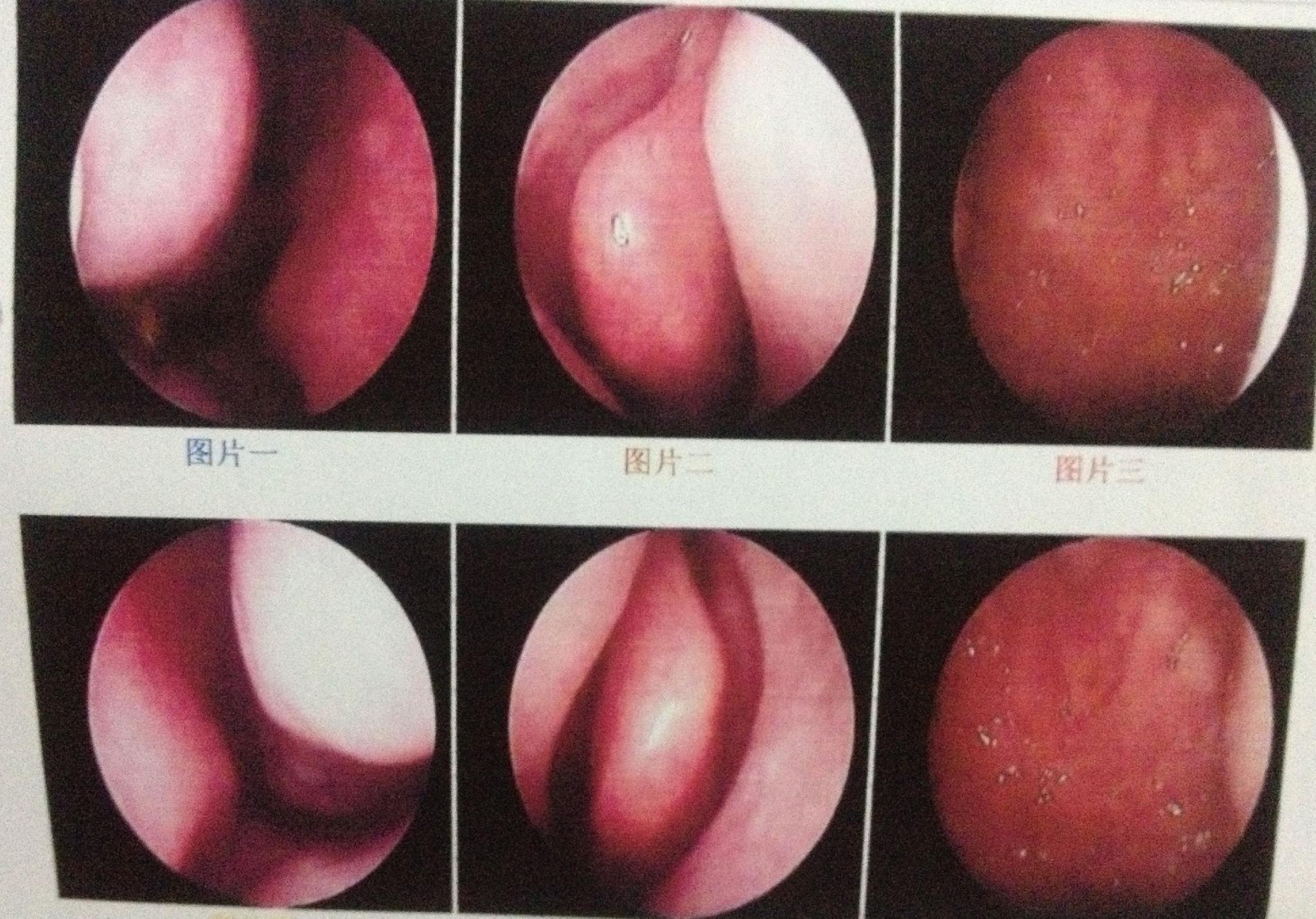 鼻咽炎组图图片