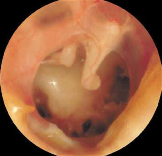 中耳炎鼓膜穿孔图片