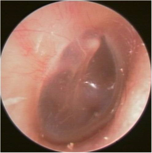 左耳鼓膜图片