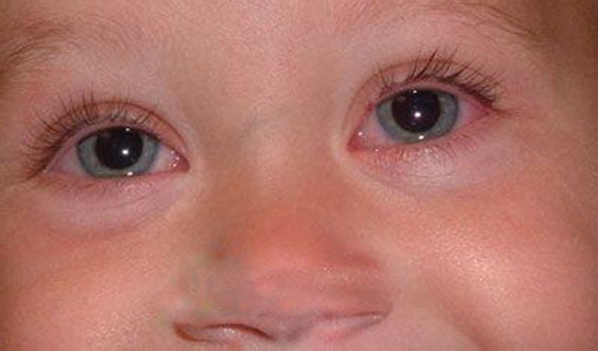儿童过敏性结膜炎双眼症状图片