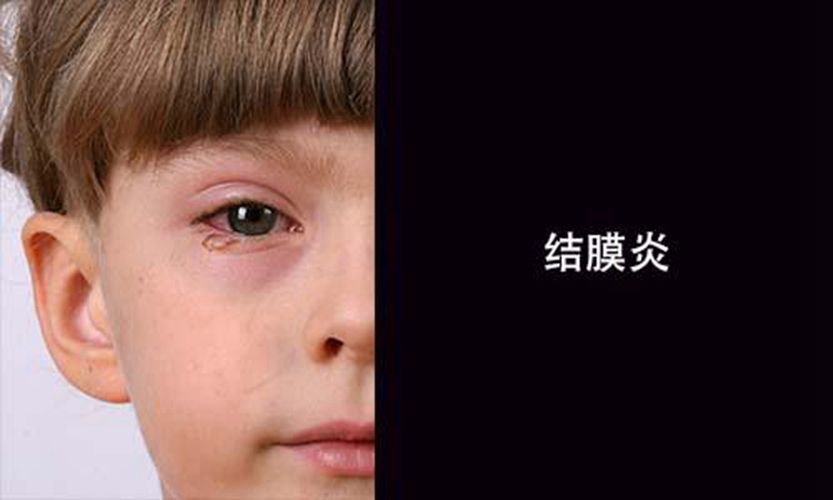 儿童过敏性结膜炎图片