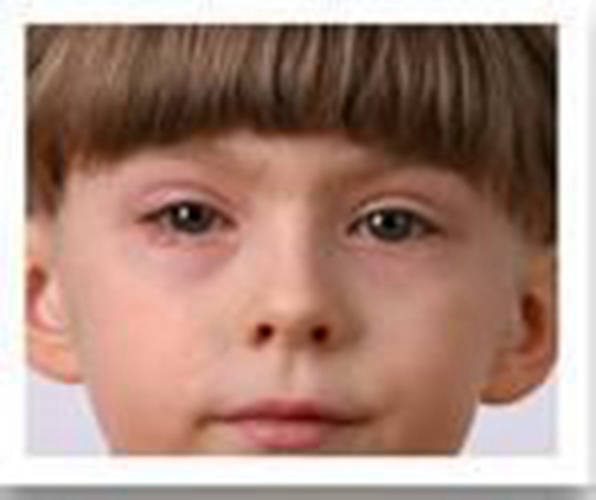 儿童双眼过敏性结膜炎症状图片