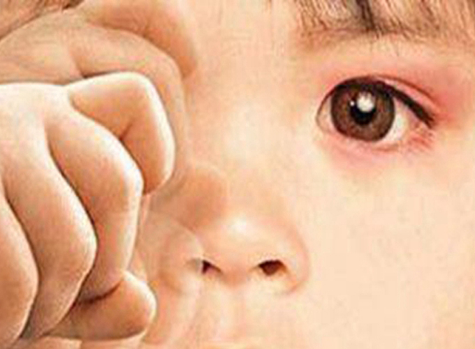 儿童左眼过敏性结膜炎图片