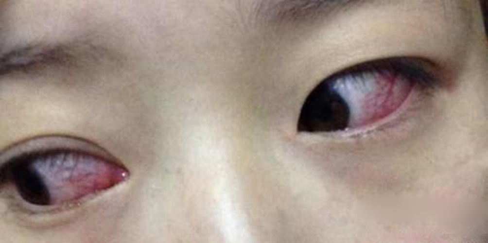过敏性结膜炎双眼症状图片