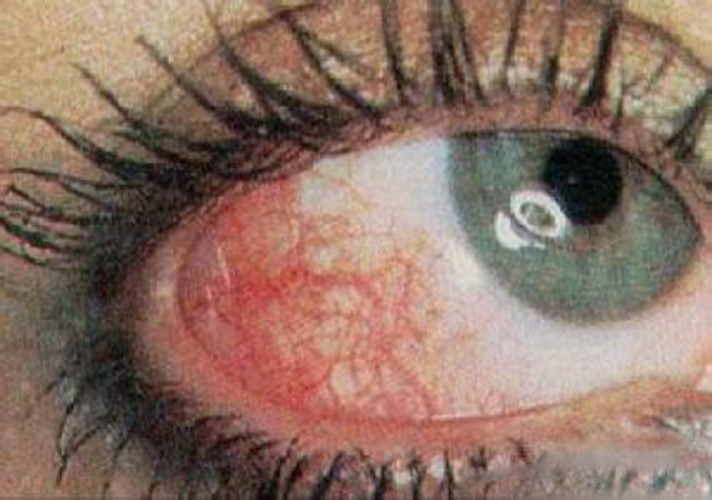 过敏性结膜炎眼角血丝症状图片