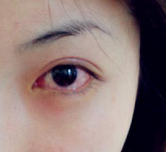 过敏性结膜炎左眼症状图片