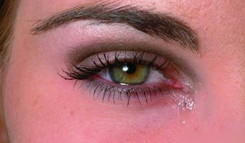 女性过敏性结膜炎流泪症状图片