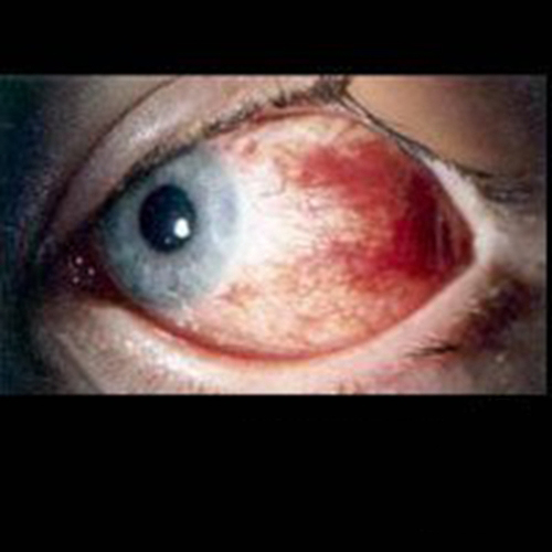 眼角血块状过敏性结膜炎图片