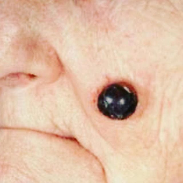 ＿脸上黑色素瘤中期症状图片