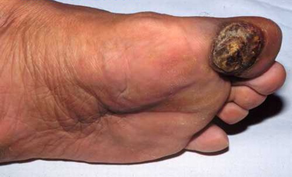 大脚趾头黑色素瘤图片图片