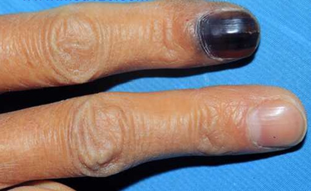 ＿手指甲黑色素瘤图片