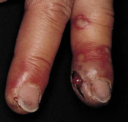 手指化脓性单纯性疱疹图片