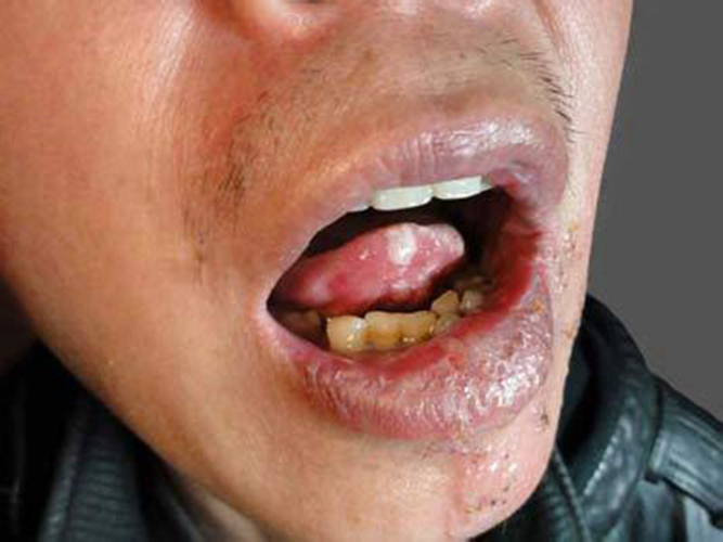 舌头疱疹症状图片