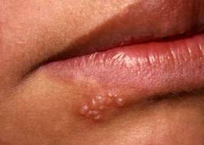 口唇疱疹初期图片