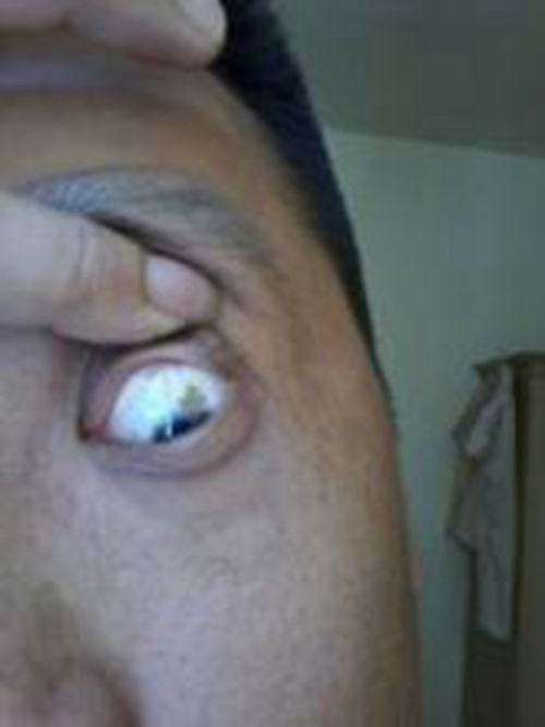 黄斑性眼病的前兆图片