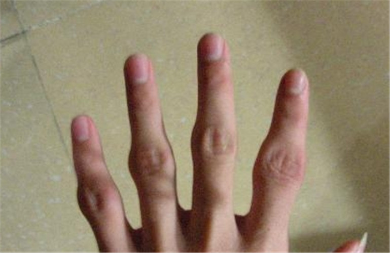 手指类风湿最早期图片图片
