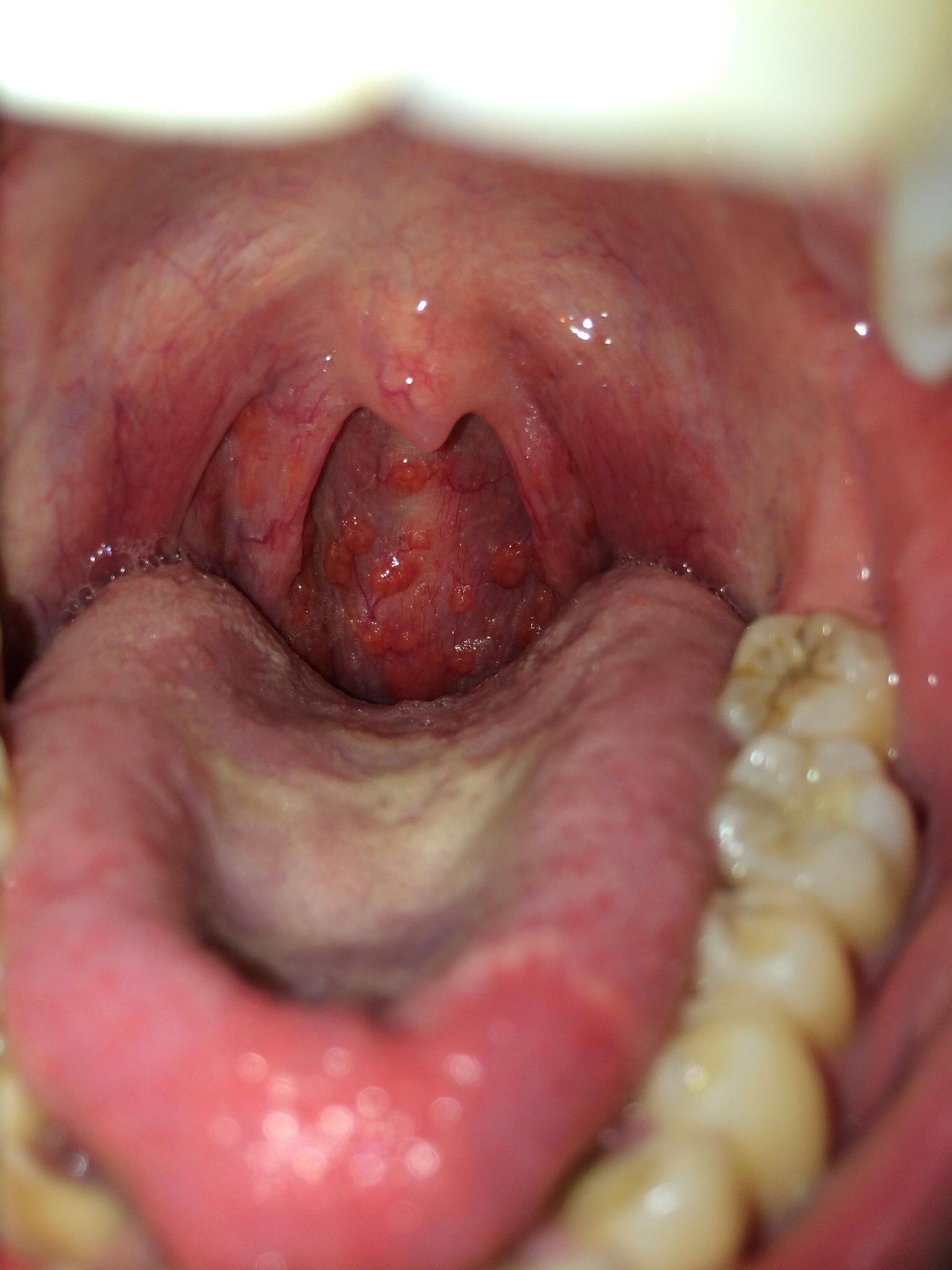喉癌的早期症状图片图片